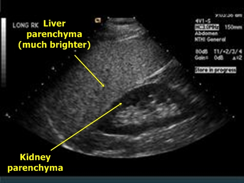 Liver steatosis - sonography