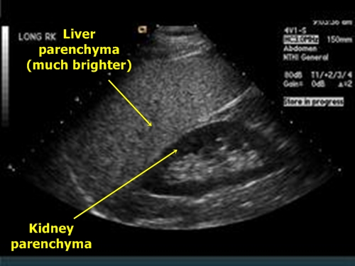 Liver steatosis - sonography