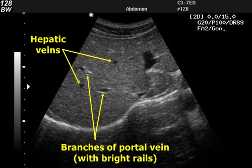 Liver vessels - sonography