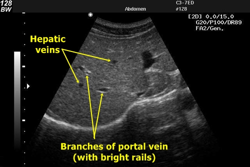 Узи сосудов печени
