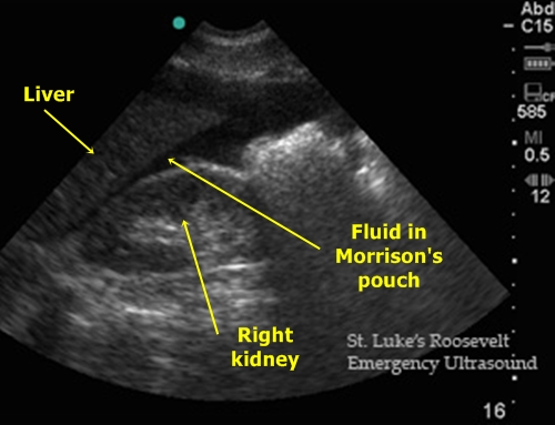 Fluid in Morrisons Pouch - Sonography