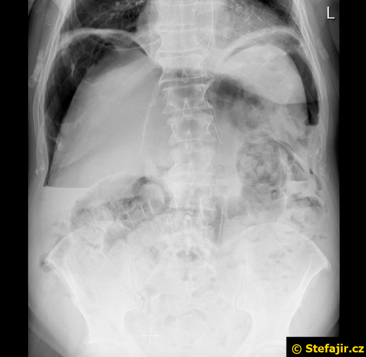 Pneumoperitoneum