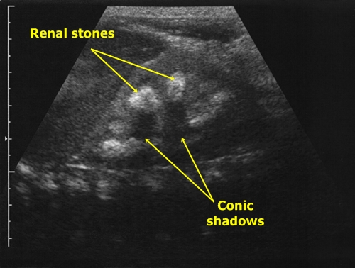 Nephrocalcinosis - sonography