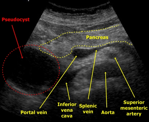 Pancreatic pseudocyst - sonography