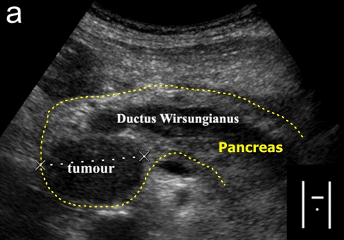 Pancreatic tumor - sonography