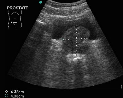 Ultrazvuk prostaty - hyperplazie prostaty