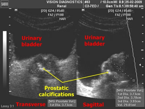 Prostate calcifications - sonography