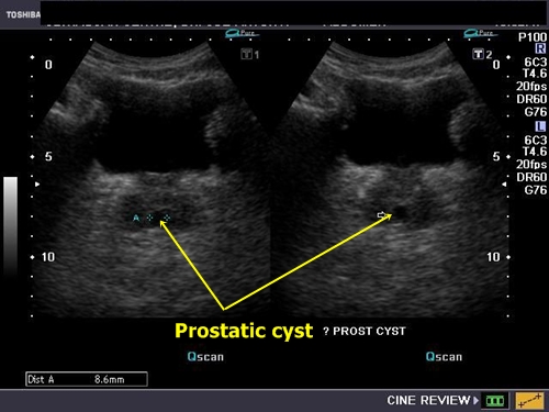 Prostatic cyst - sonography