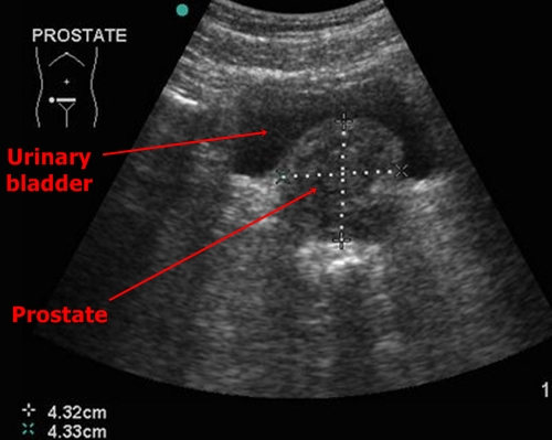 Prostate hyperplasia - sonography