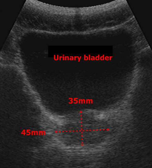 normal prostate ultrasound simptomele de prostata la barbati