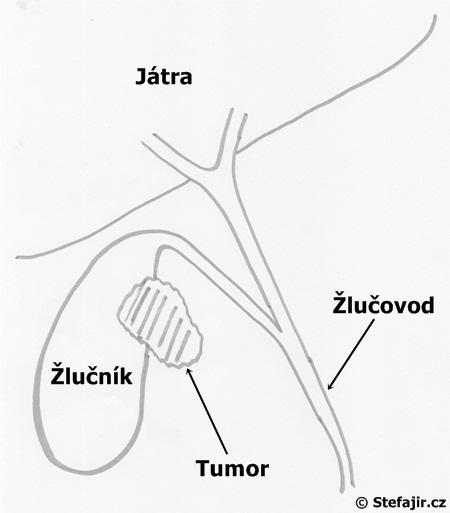 Tumor zlucniku - schema