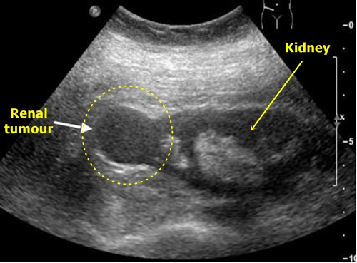 Kidney tumor - sonography