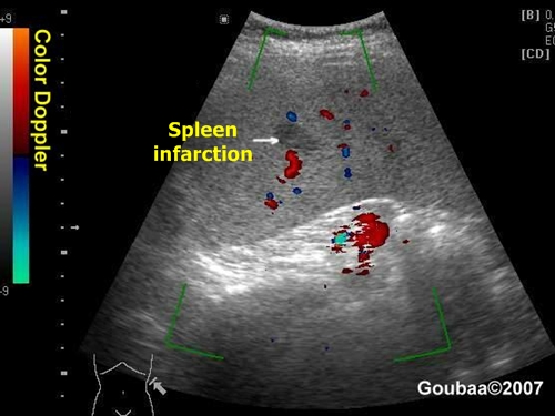Spleen infarction - sonography