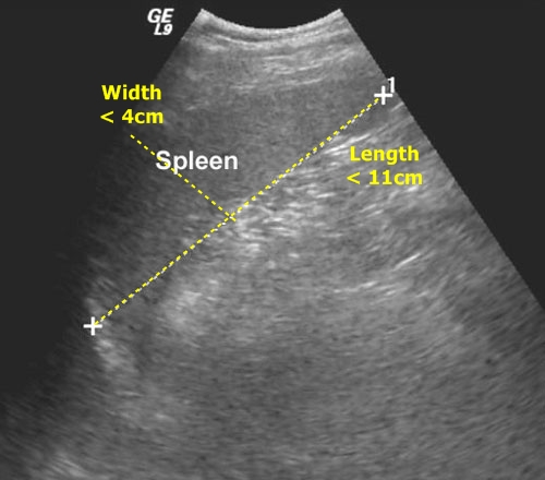 Spleen - sonography