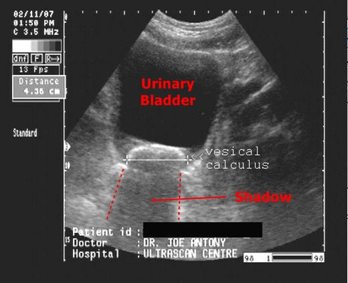 Urinary bladder stone - sonography