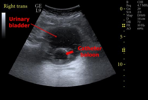 Urinary catheter - sonography