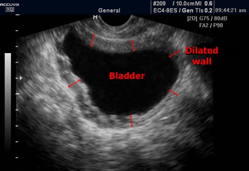 Cystitis - sonography