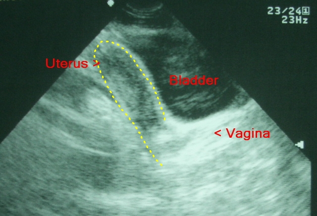 Urinary bladder - sonography