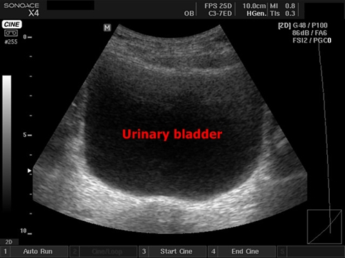 Urinary bladder - sonography