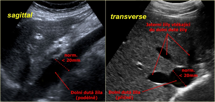 Ultrazvuk dolni dute zily