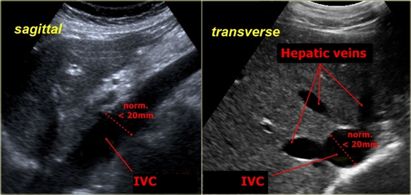 Inferior vena cava - sonography