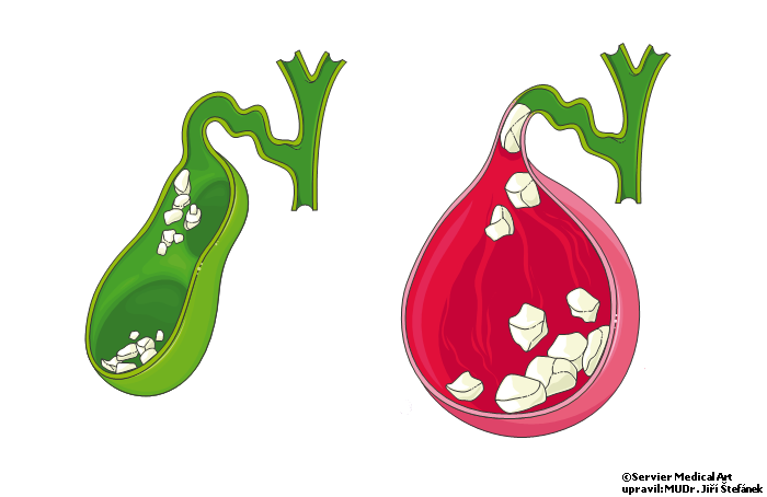 Jak se projevuje zánět žlučníku?