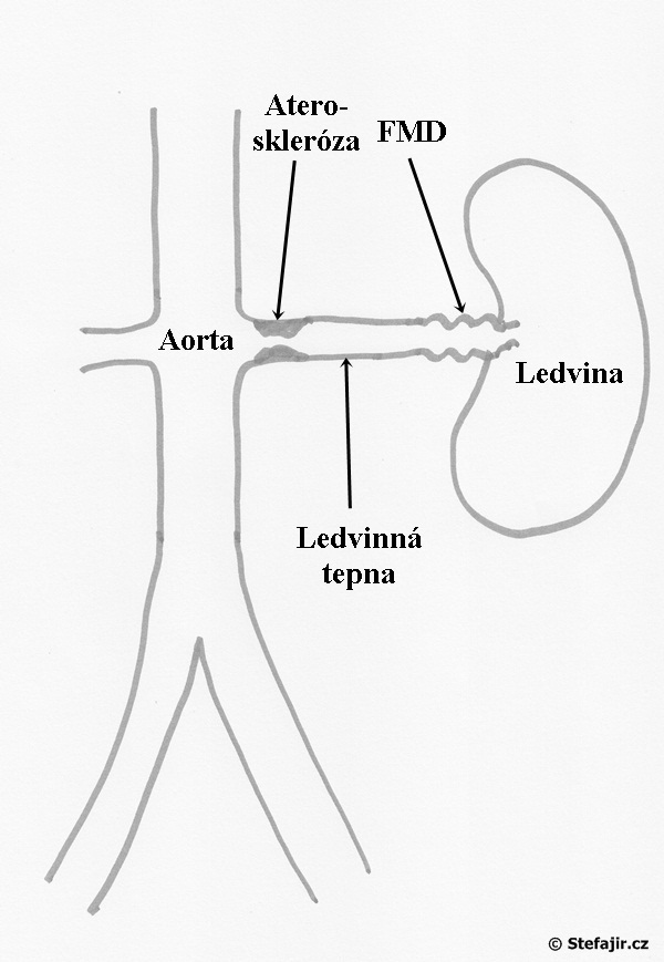 Zuzeni ledvinnych tepen - schema