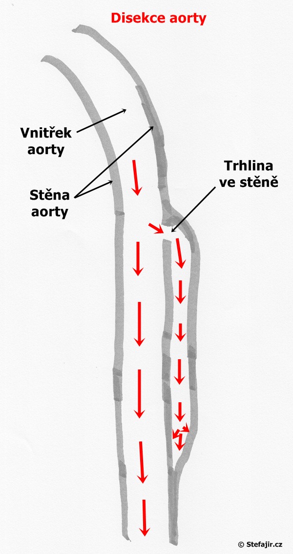 Co to je Disekce?