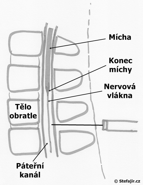 Co je to lumbální punkce?