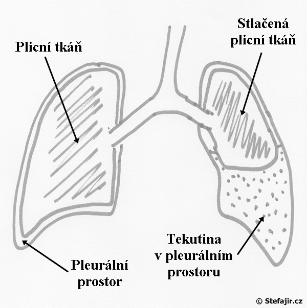 Jak se dostane voda do plic?